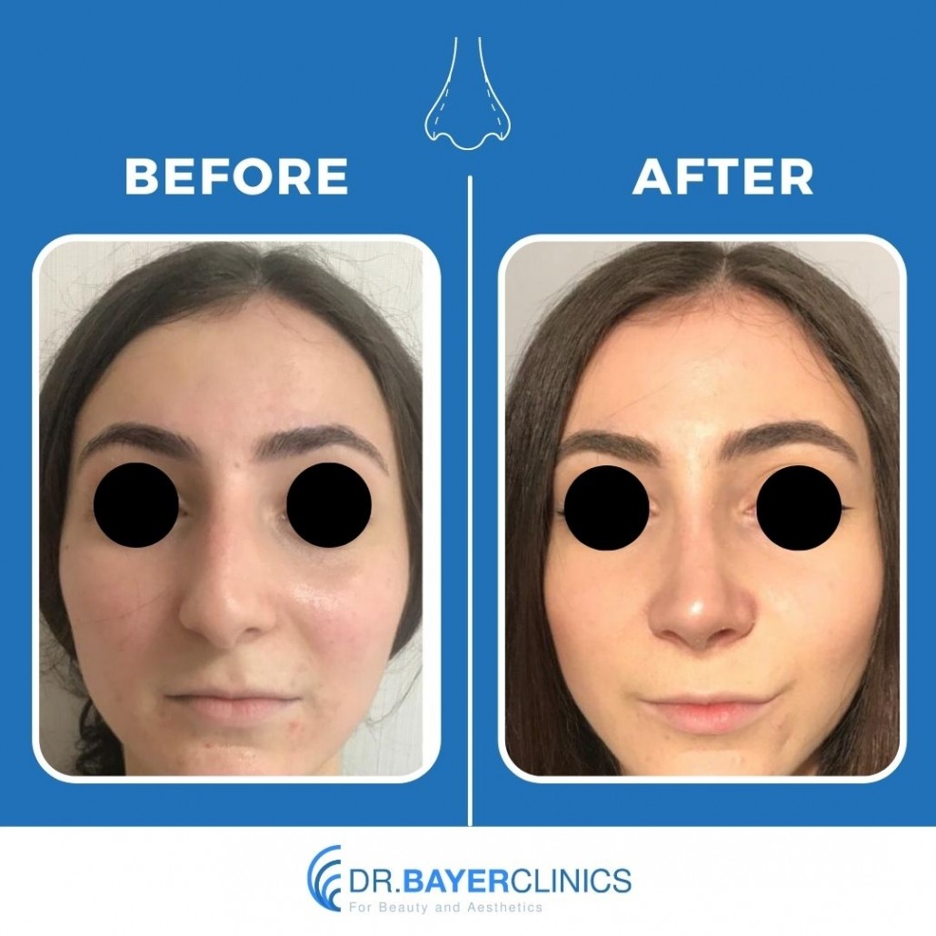 Nose Job Rhinoplasty Before and After Gallery 14