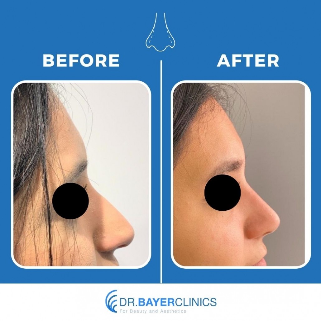 long nose rhinoplasty before and after