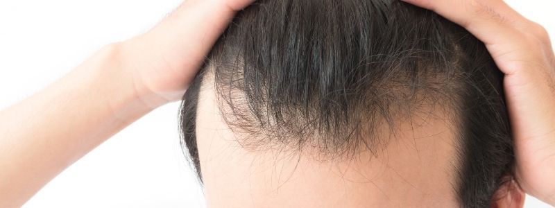 Kann eine Haartransplantation bei feinem Haar wirken