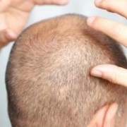 Kopf Gestoßen Nach Haartransplantation