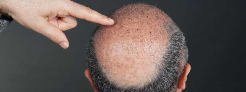 Kopfhaut nach Haartransplantation
