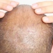 Kopfmassage nach Haartransplantation