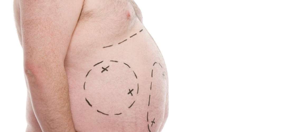 Male Liposuction in Turkey