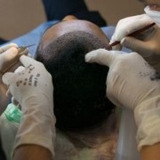 Narben nach Haartransplantation