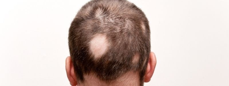 Was ist Alopezie Areata