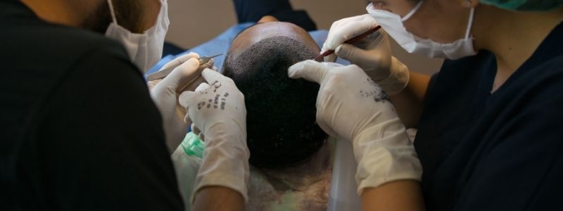 Was Sind Die Schritte Einer Haartransplantation?