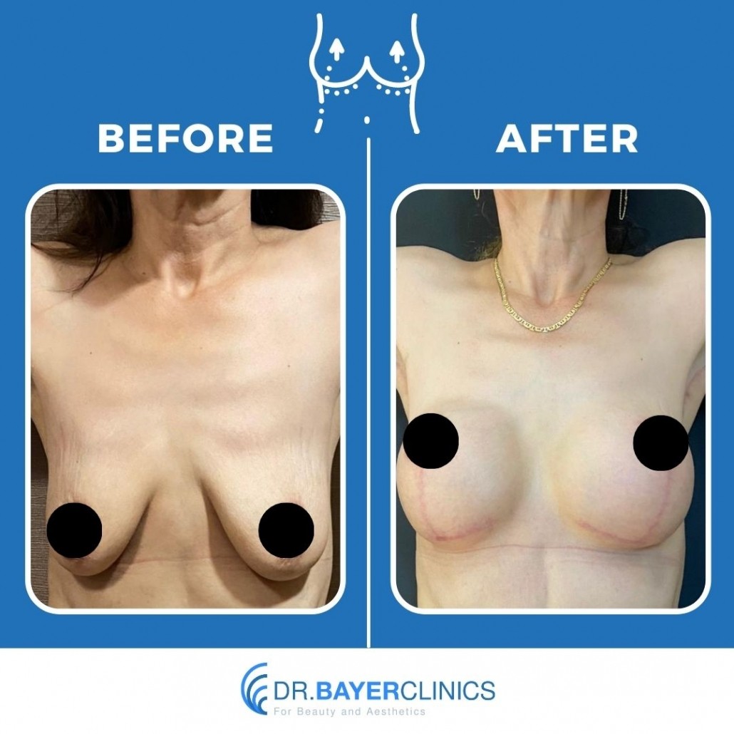 Breast Augmentation Before After Photos 3