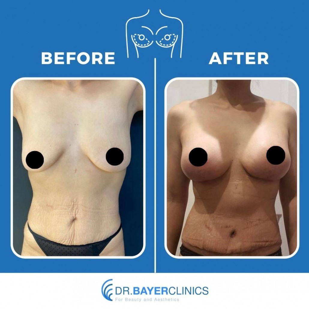 Breast Augmentation Before After Photos 6