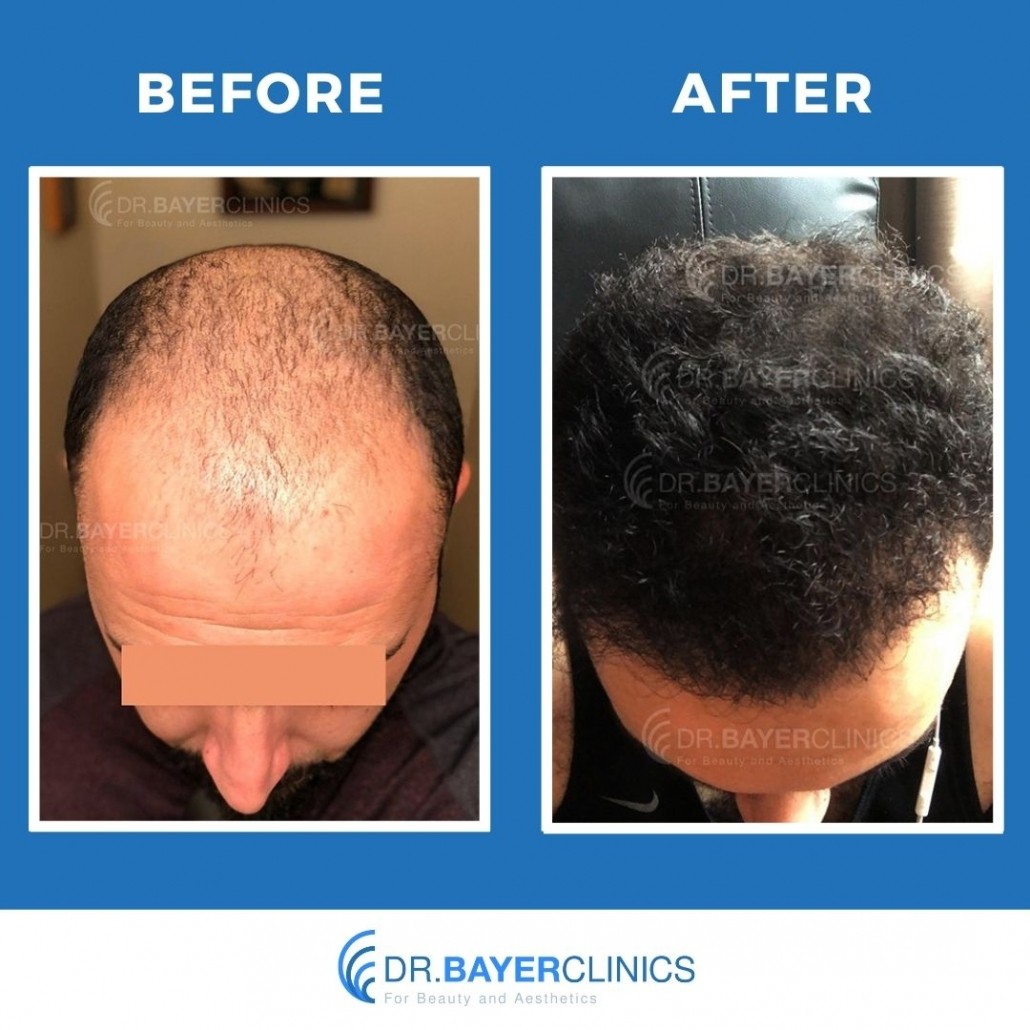 hair transplant before and after male crown area in turkey
