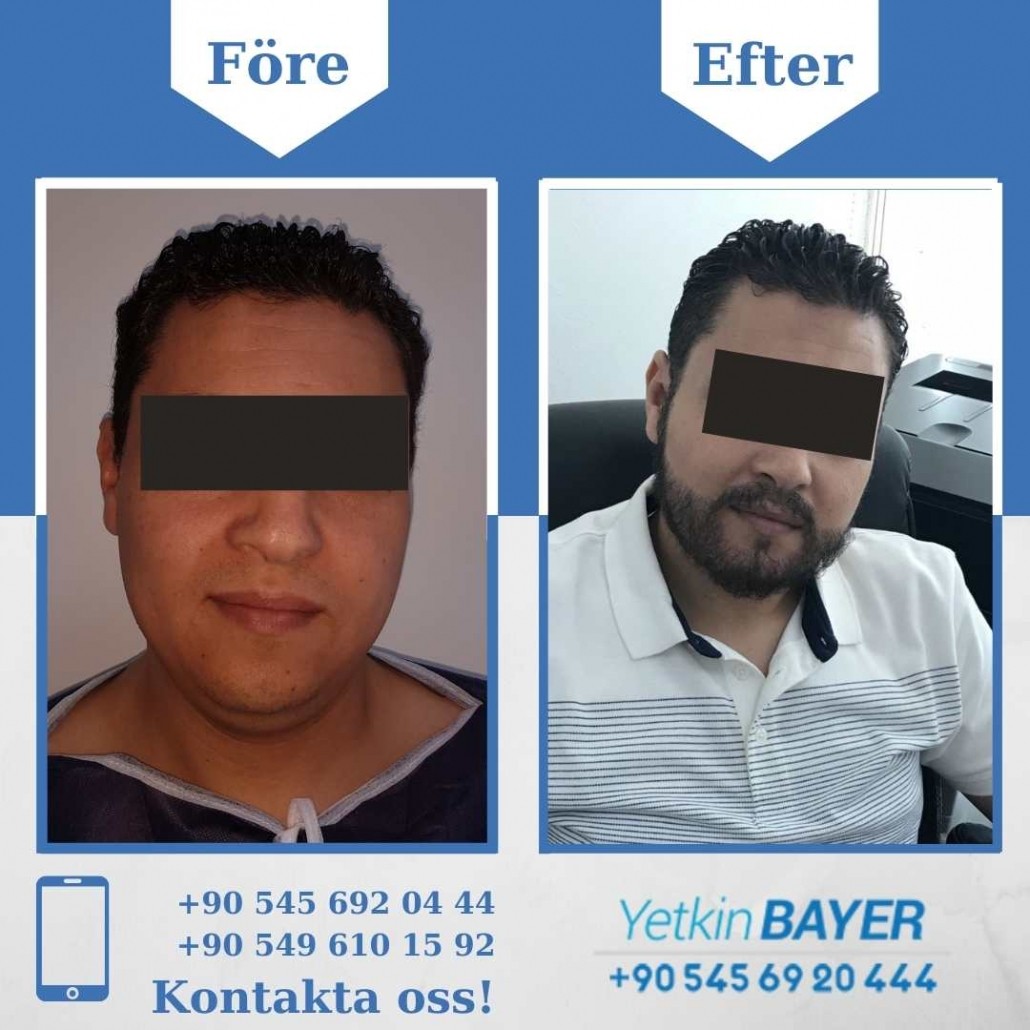 Resultat före och efter en hårtransplantation (bilder) 4