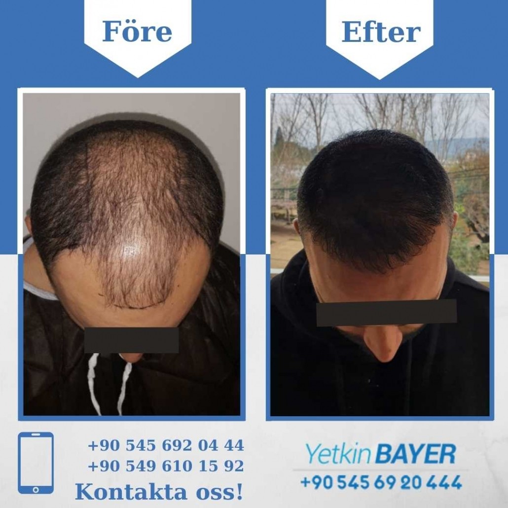 Resultat före och efter en hårtransplantation (bilder) 26