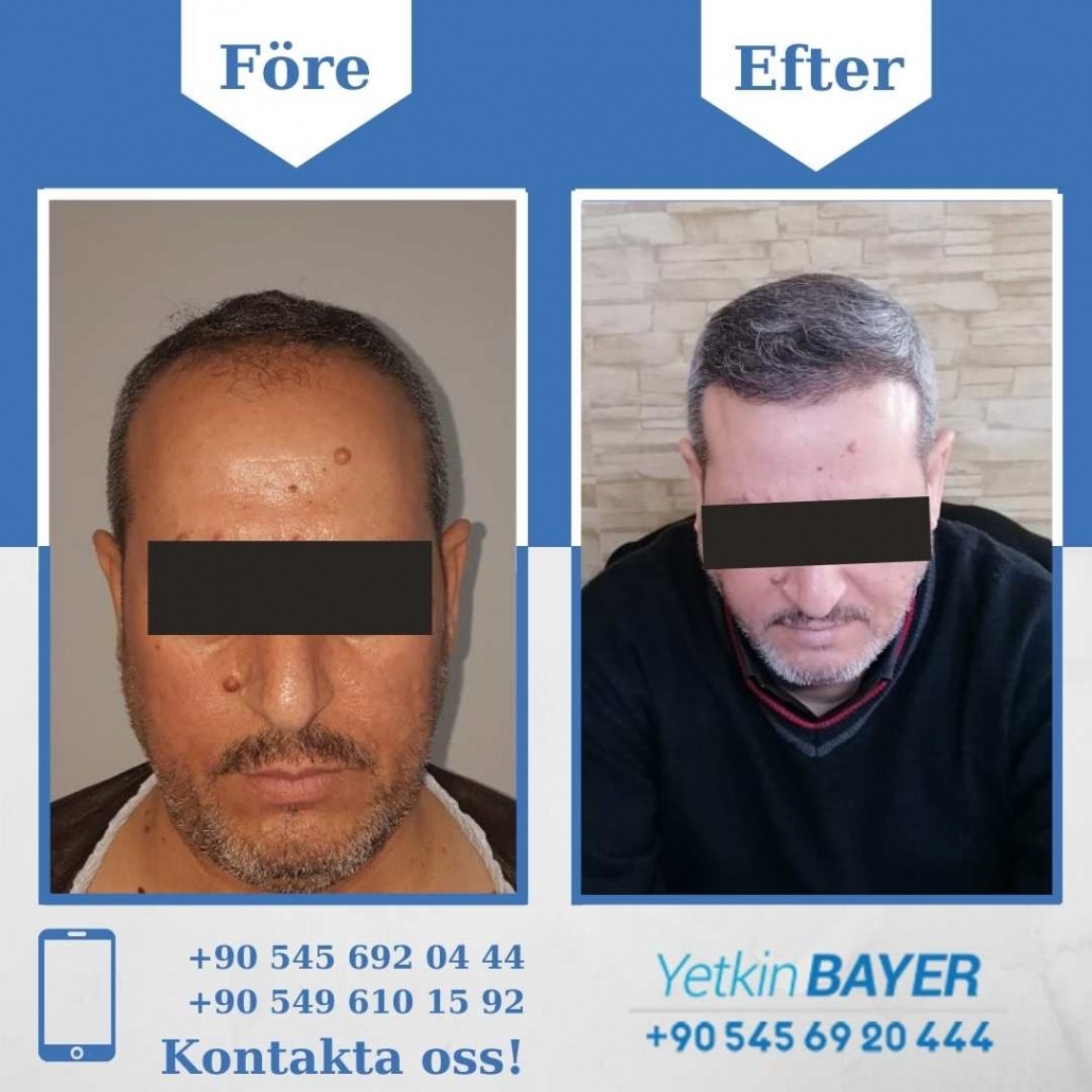 Resultat före och efter en hårtransplantation (bilder) 7