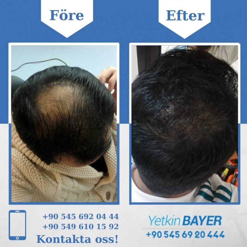 Resultat före och efter en hårtransplantation (bilder) 4