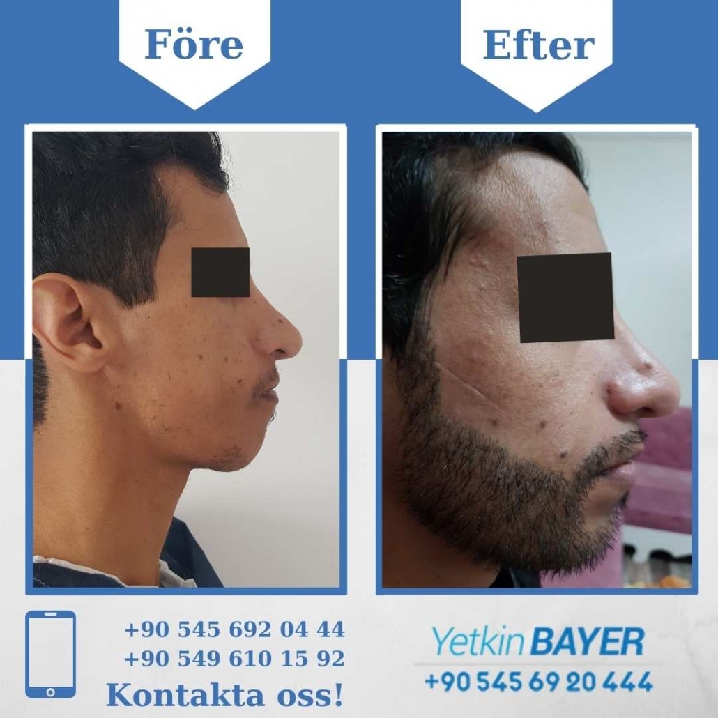 Resultat före och efter en hårtransplantation (bilder) 5