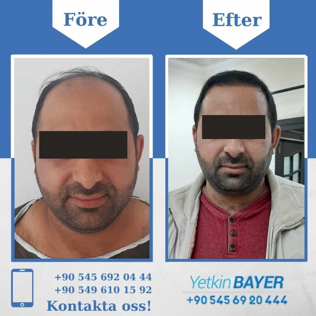 Resultat före och efter en hårtransplantation (bilder) 25