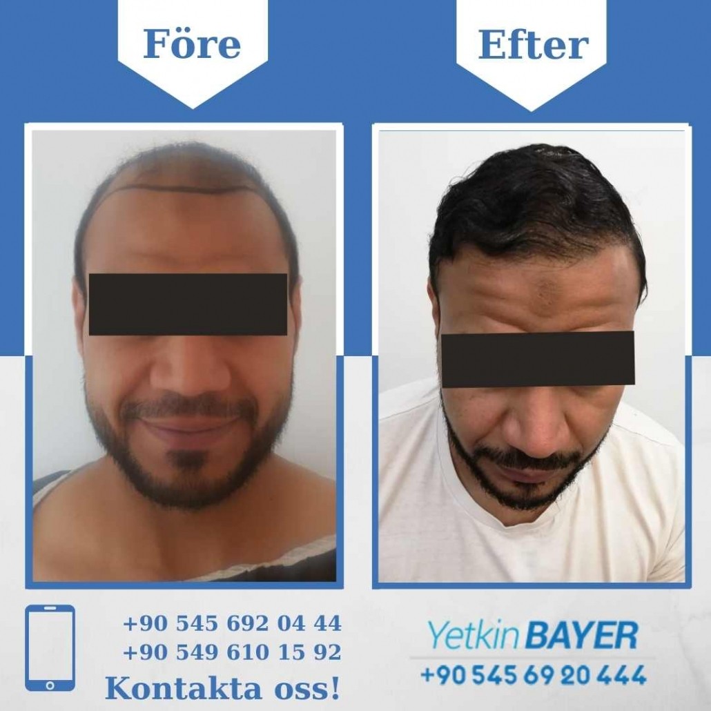 Resultat före och efter en hårtransplantation (bilder) 24