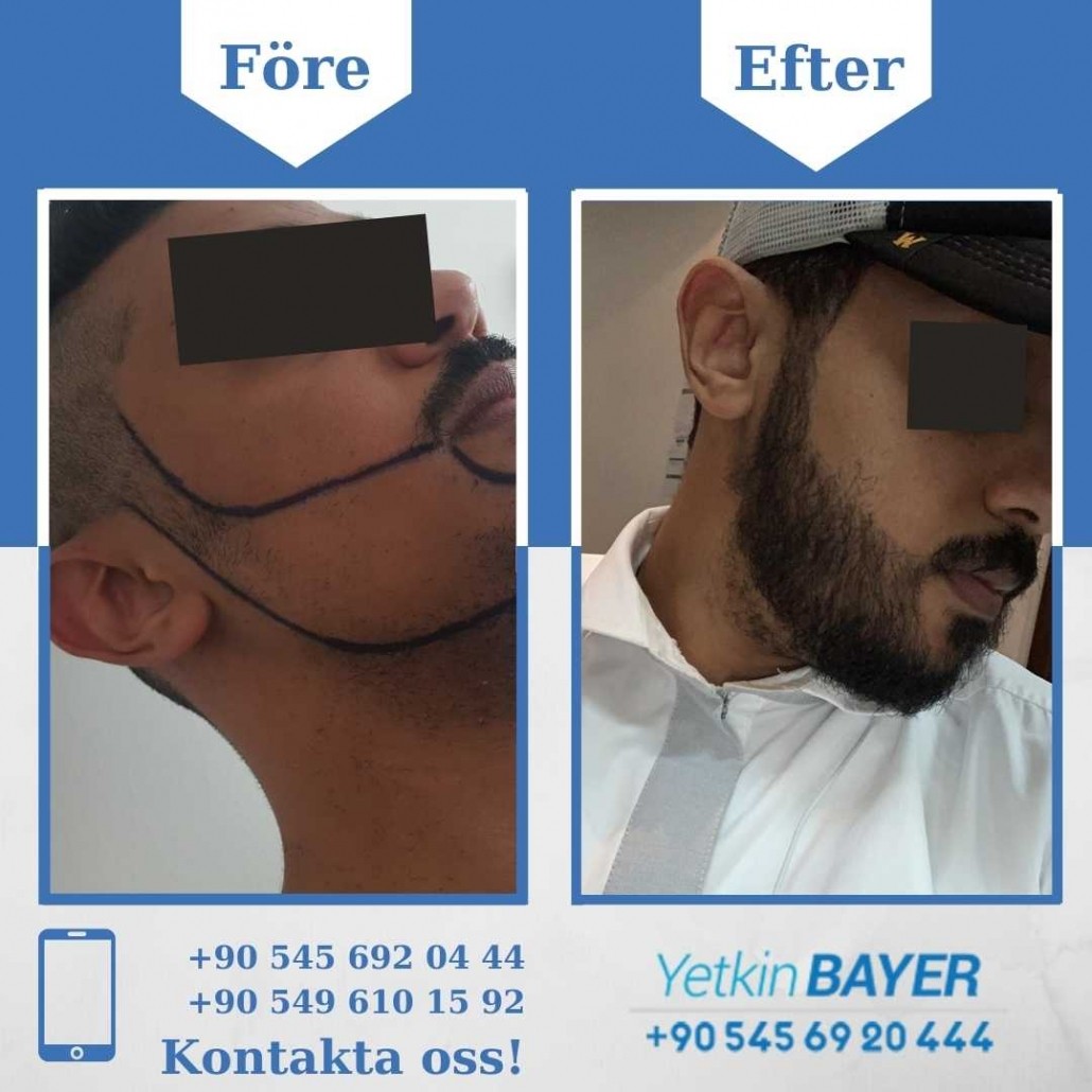 Resultat före och efter en hårtransplantation (bilder) 20