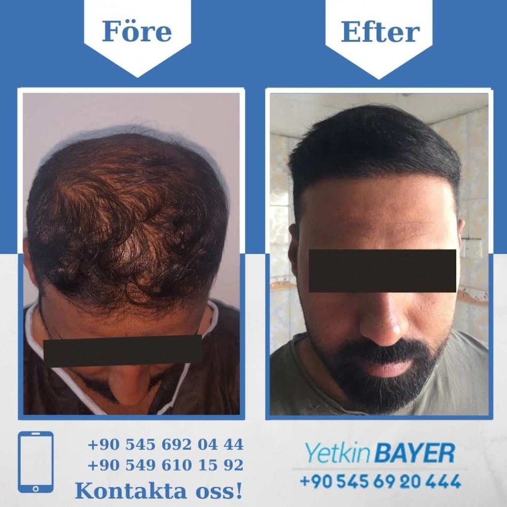 Resultat före och efter en hårtransplantation (bilder) 17