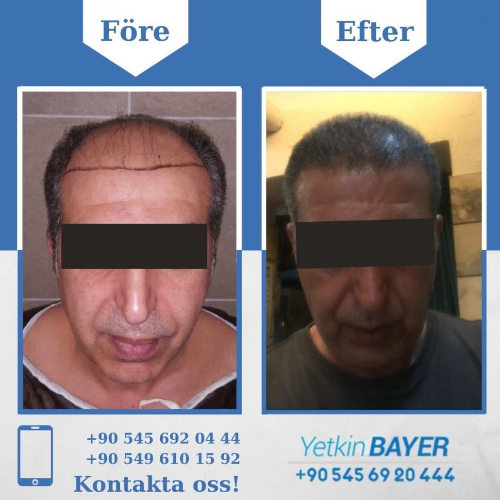Resultat före och efter en hårtransplantation (bilder) 23