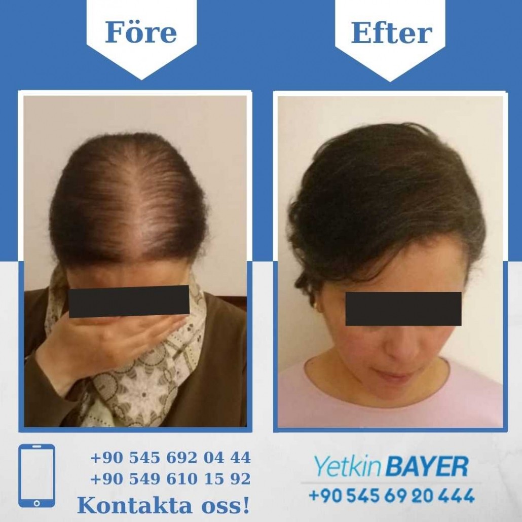 hårtransplantation kvinna resultat