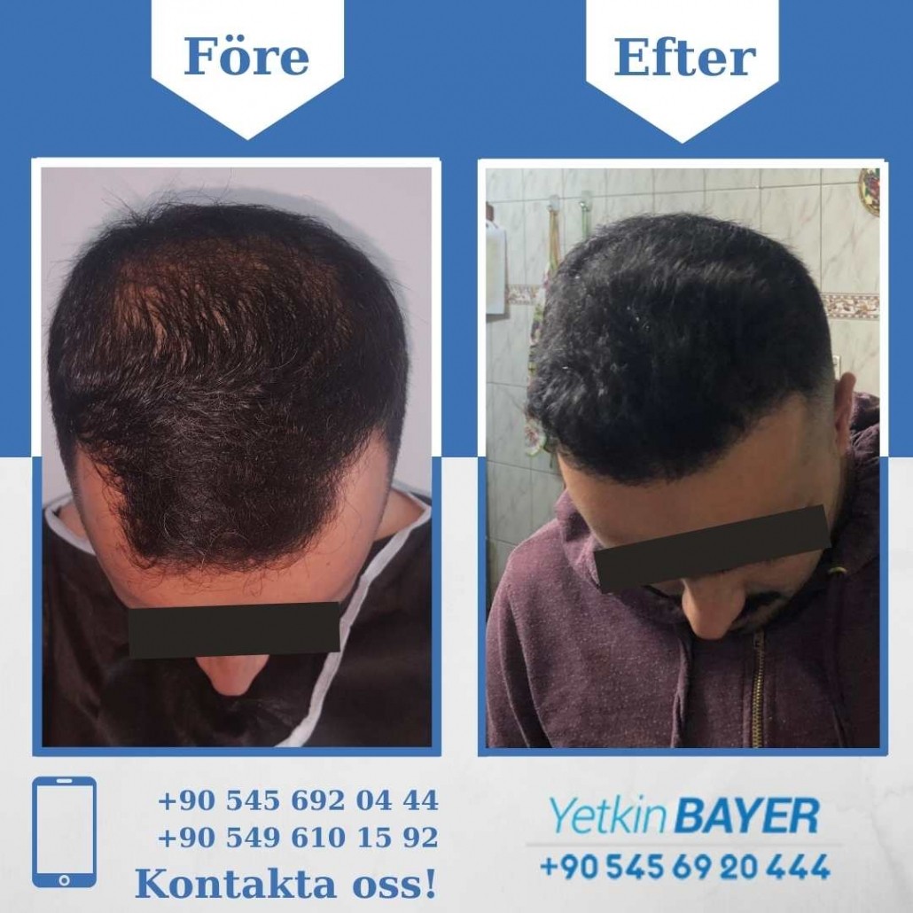 Resultat före och efter en hårtransplantation (bilder) 12