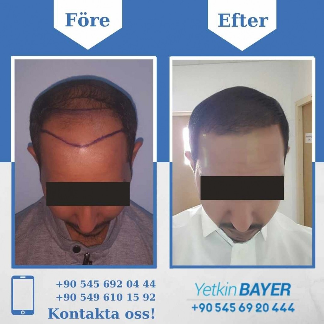 Resultat före och efter en hårtransplantation (bilder) 5