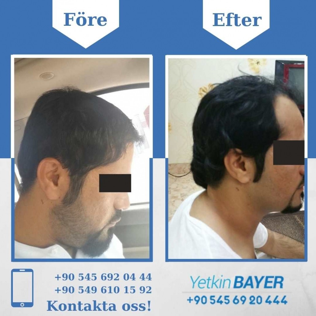 Resultat före och efter en hårtransplantation (bilder) 28