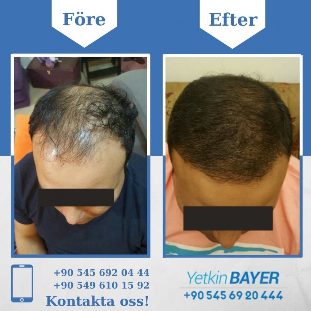 Resultat före och efter en hårtransplantation (bilder) 27