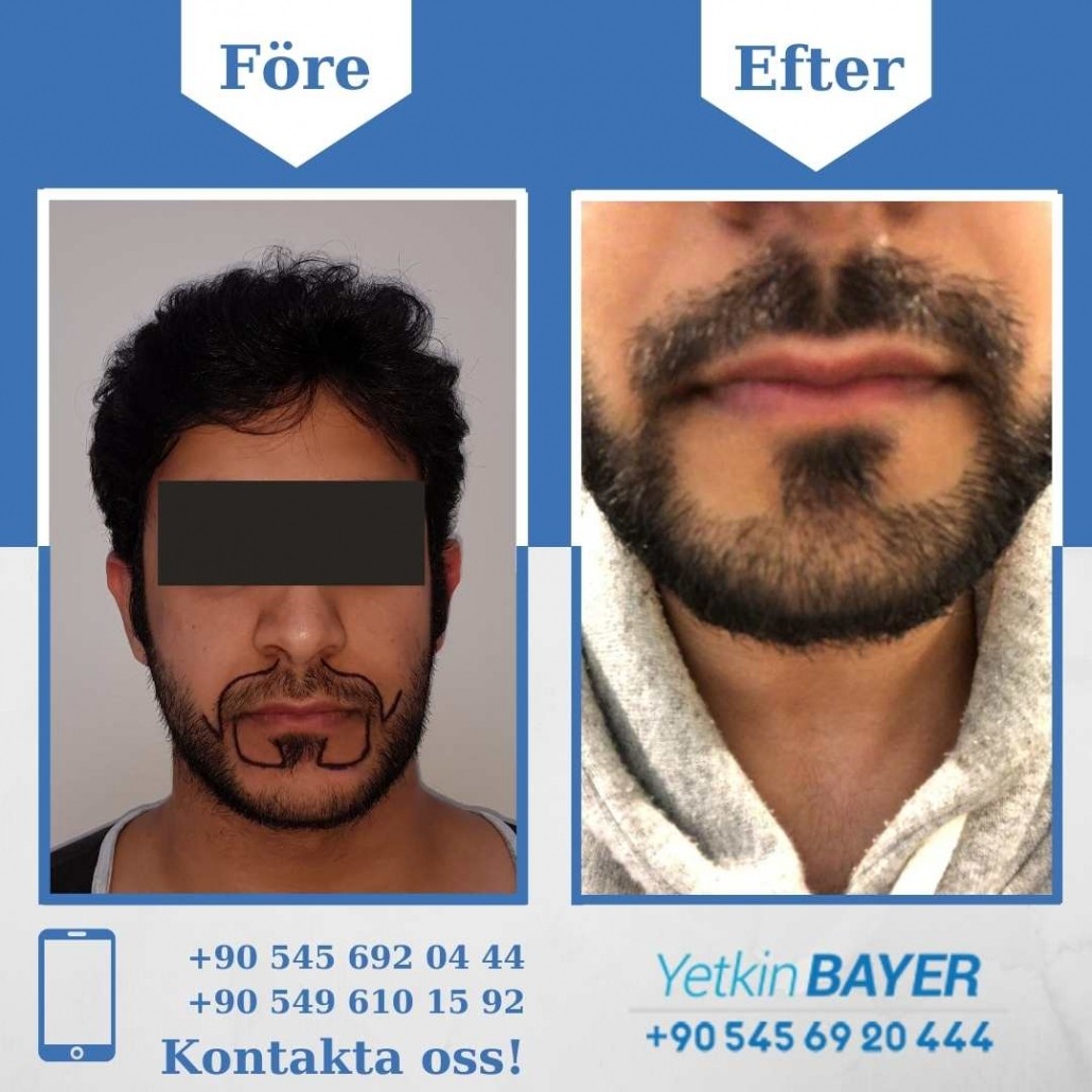 Resultat före och efter en hårtransplantation (bilder) 30
