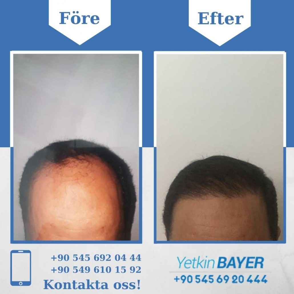 Resultat före och efter en hårtransplantation (bilder) 14