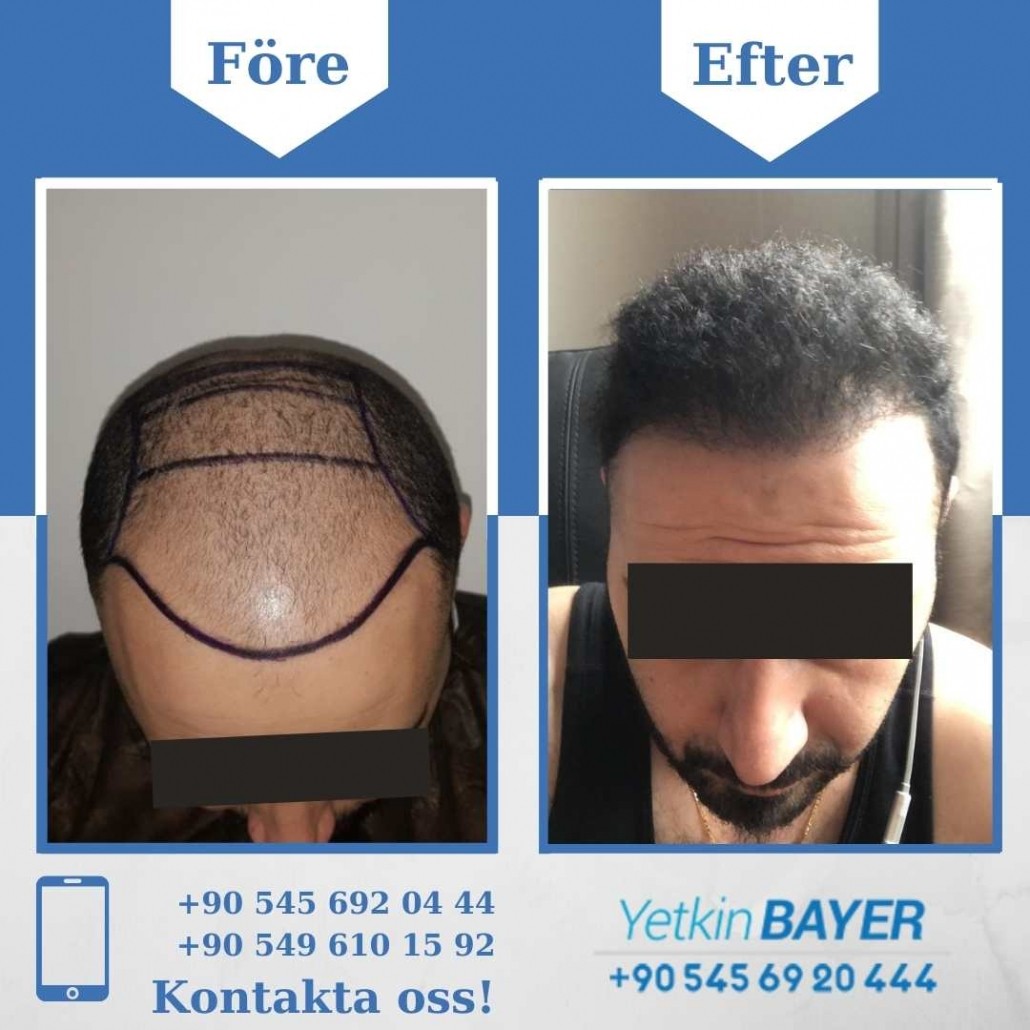 Resultat före och efter en hårtransplantation (bilder) 20