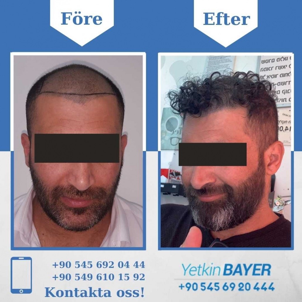 Resultat före och efter en hårtransplantation (bilder) 15
