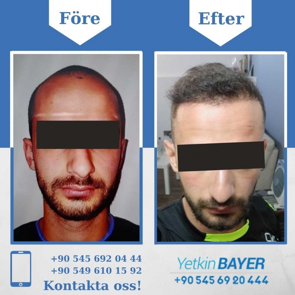 Resultat före och efter en hårtransplantation (bilder) 14