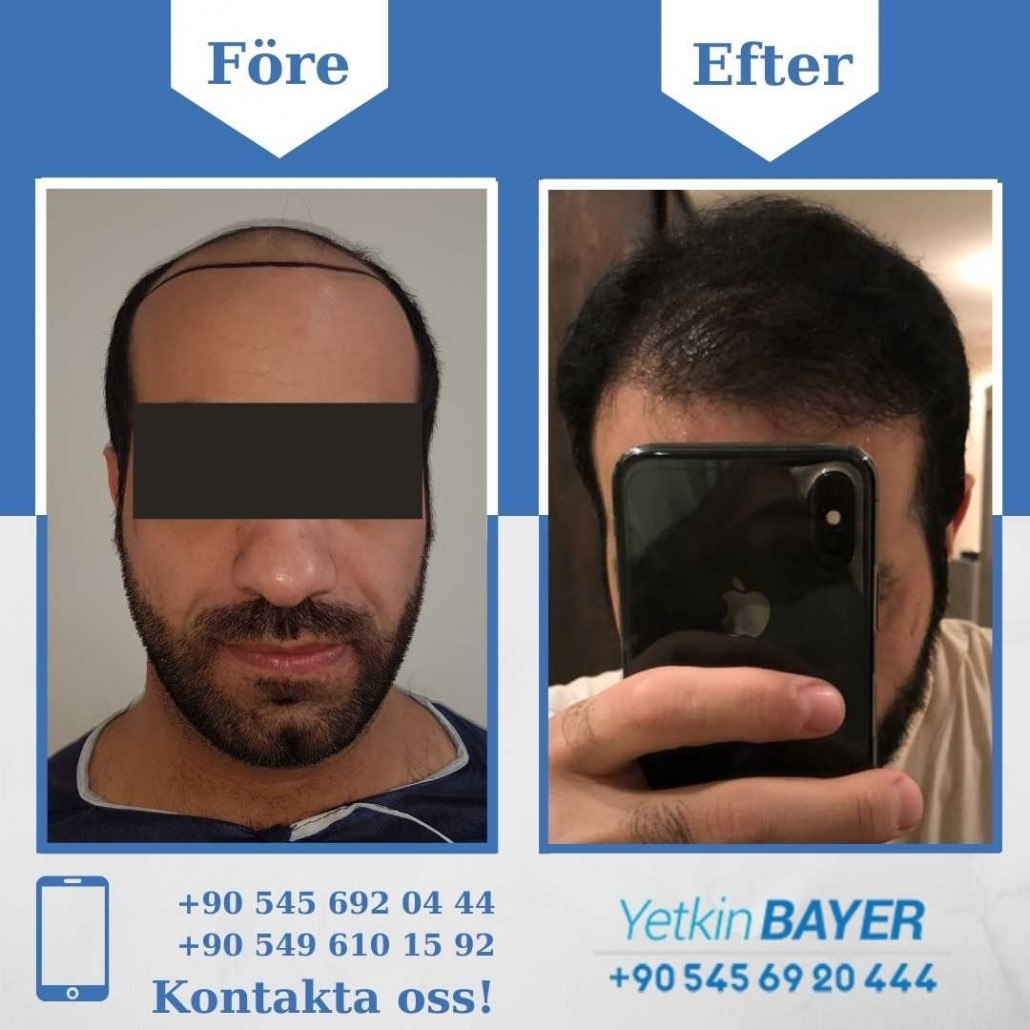 Resultat före och efter en hårtransplantation (bilder) 11