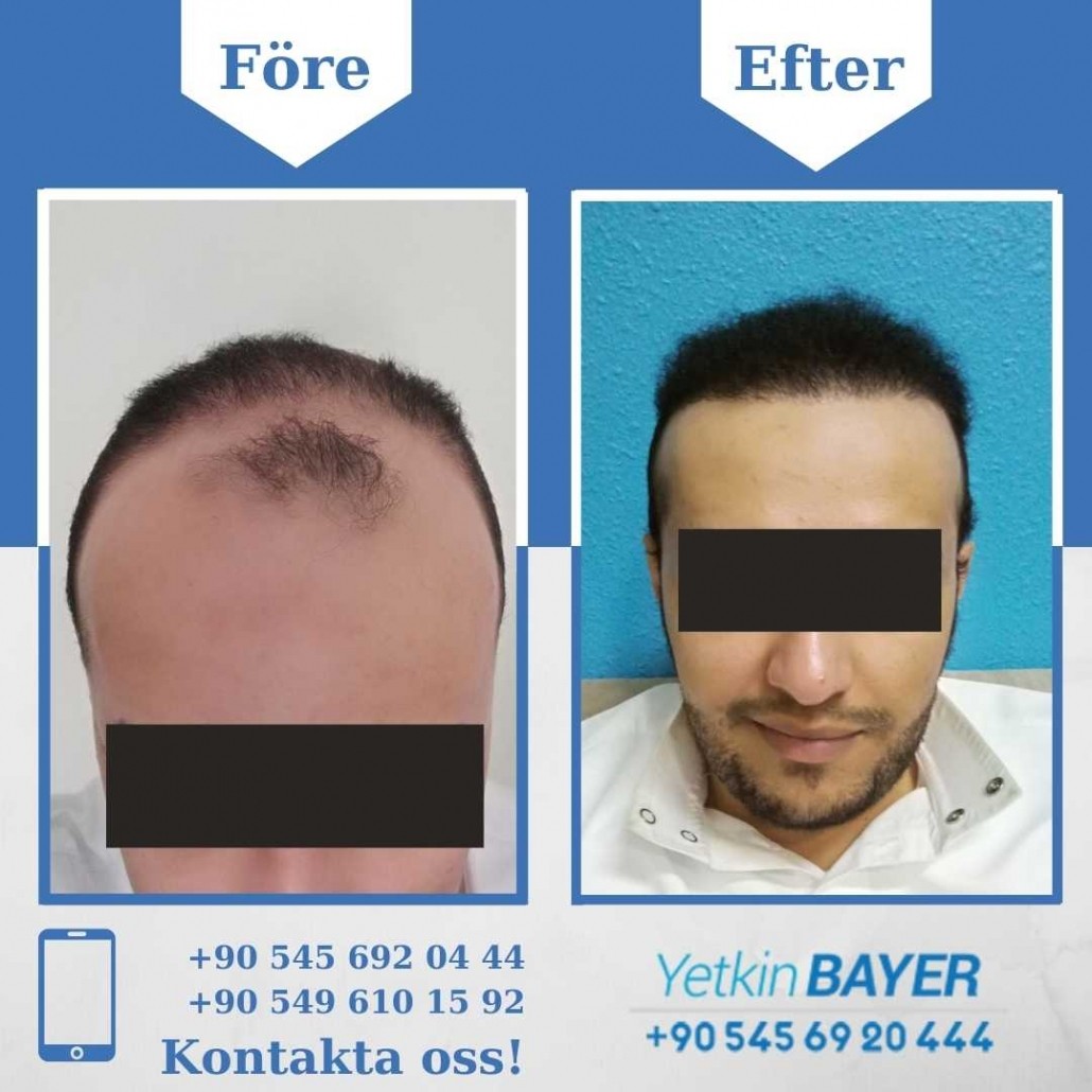 hårtransplantation före och efter bilder