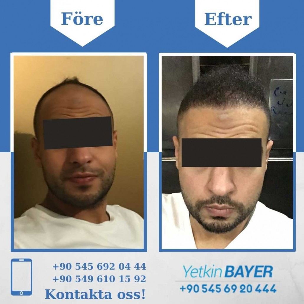 Resultat före och efter en hårtransplantation (bilder) 1
