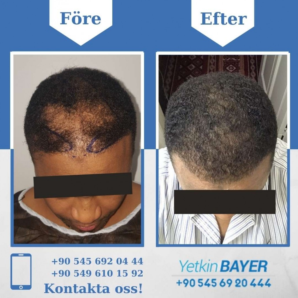 Resultat före och efter en hårtransplantation (bilder) 19