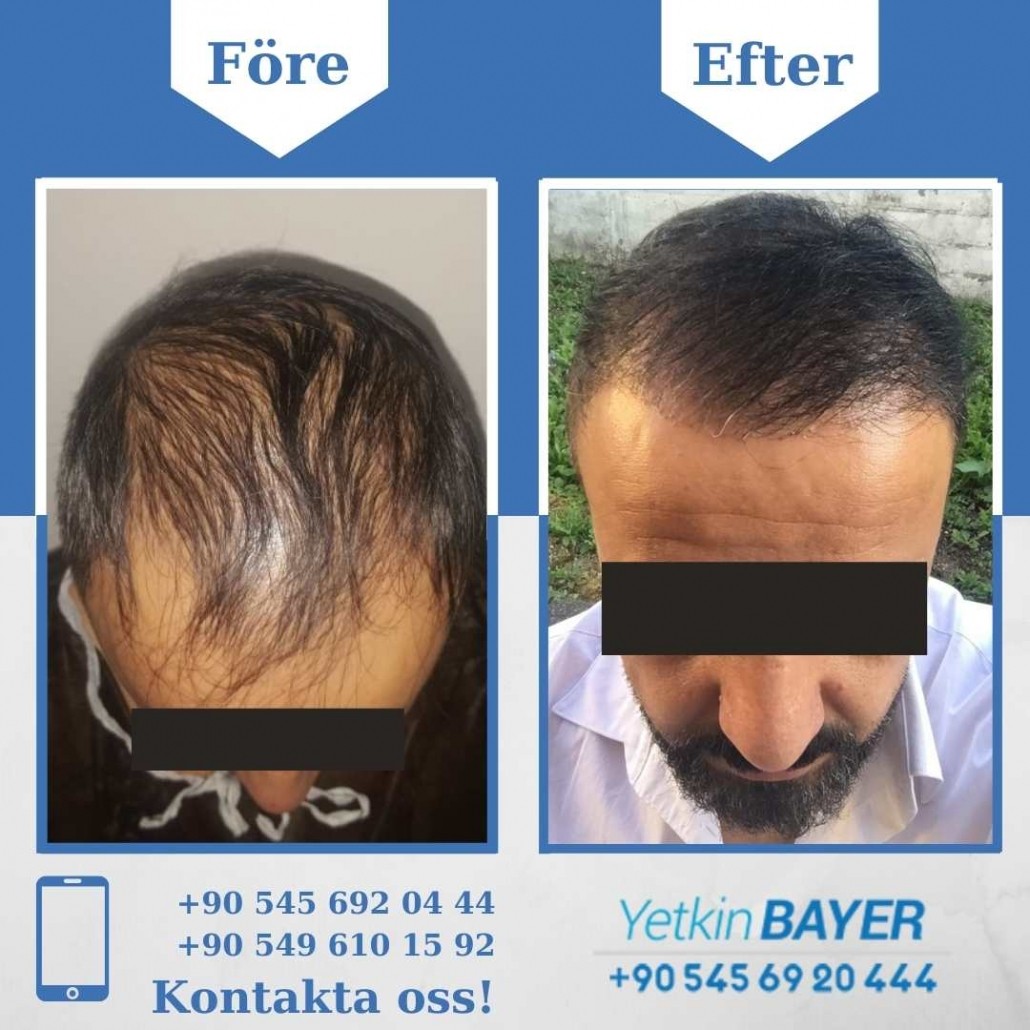 Resultat före och efter en hårtransplantation (bilder) 19