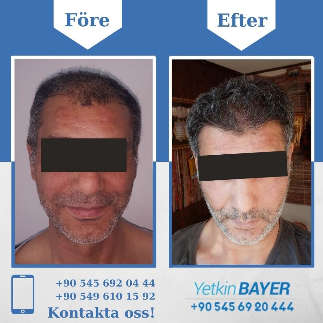 Resultat före och efter en hårtransplantation (bilder) 16