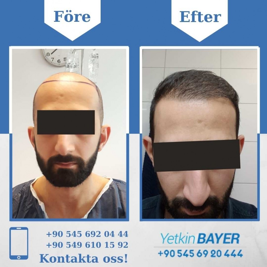 Resultat före och efter en hårtransplantation (bilder) 9