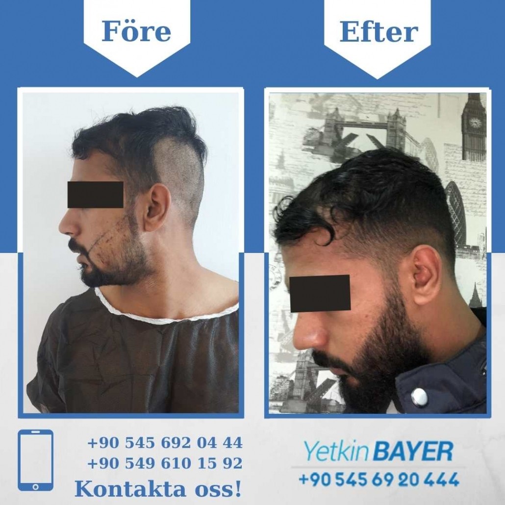 Resultat före och efter en hårtransplantation (bilder) 8