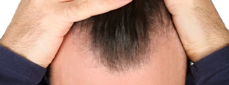 Kann eine Haartransplantation den zurückweichenden Haaransatz beheben