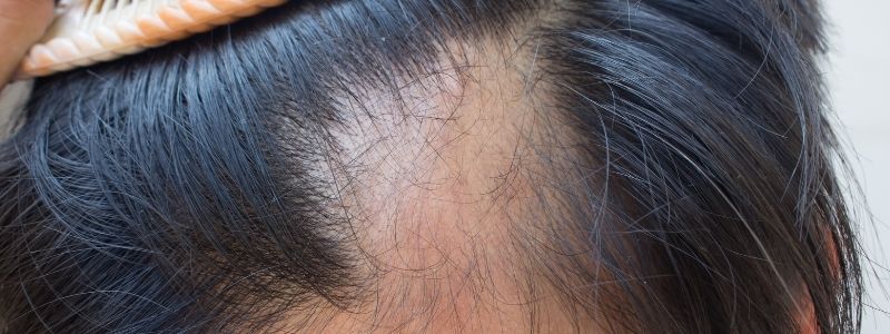Kann man bei diffusem Haarausfall eine Haartransplantation durchführen lassen