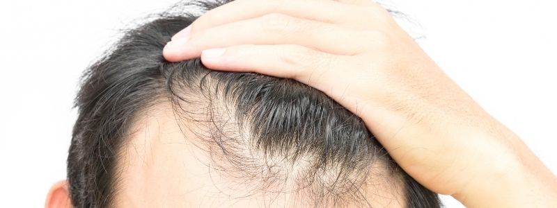 Kann man bei dünner werdendem Haar eine Haartransplantation durchführen