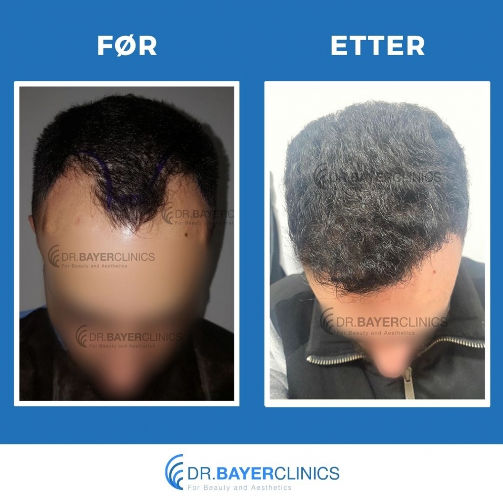Før og etter hårtransplantasjon 13