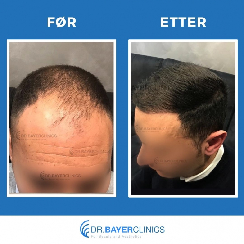 Før og etter hårtransplantasjon 9