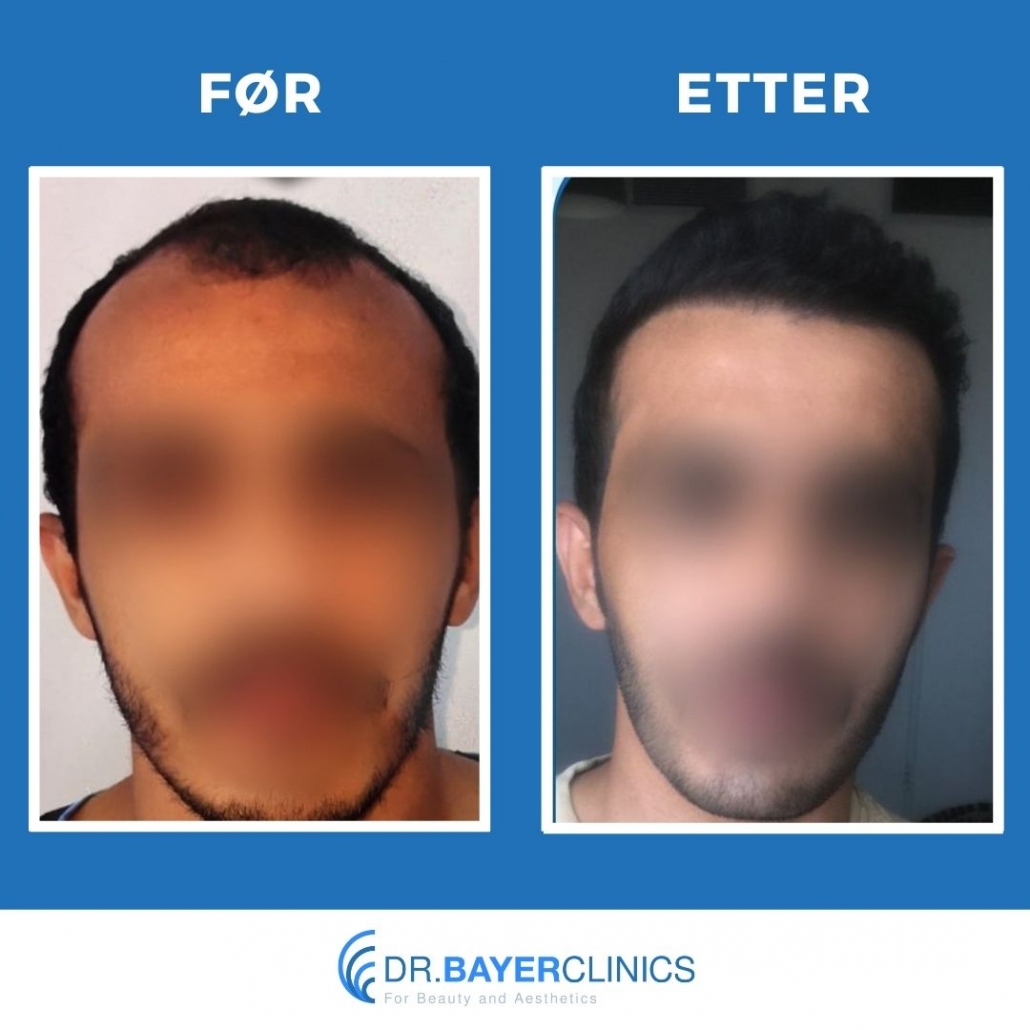 Før og etter hårtransplantasjon 10