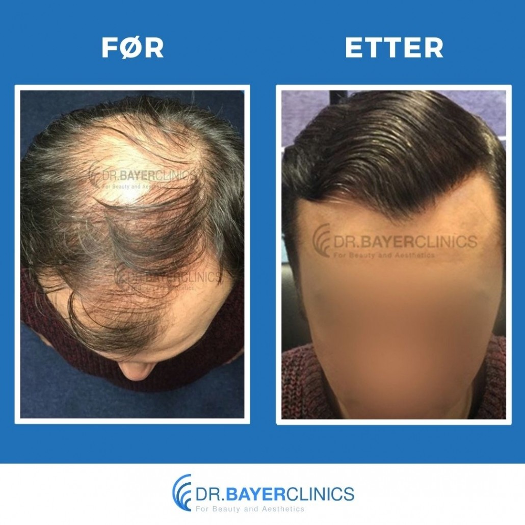 Før og etter hårtransplantasjon 9
