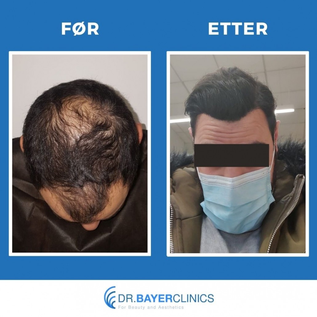 Før og etter hårtransplantasjon 5