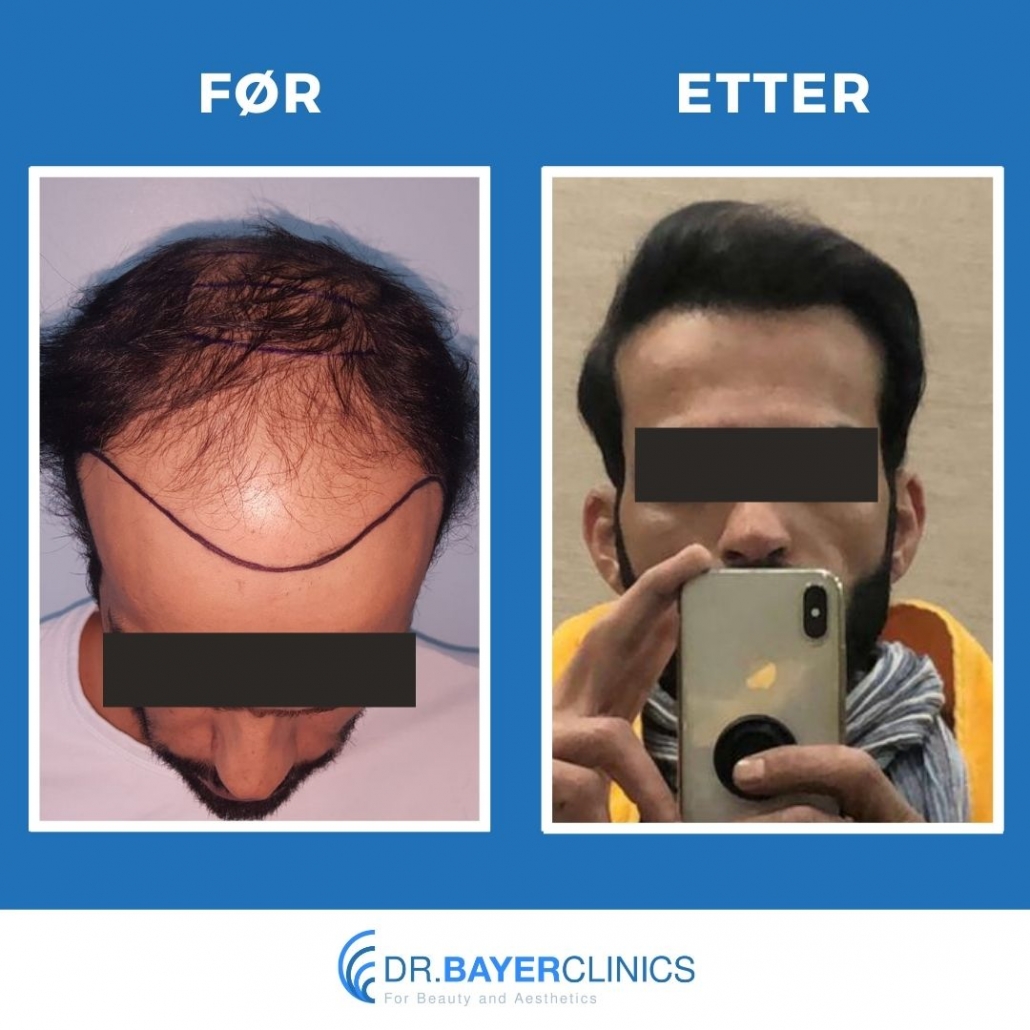 Før og etter hårtransplantasjon 3